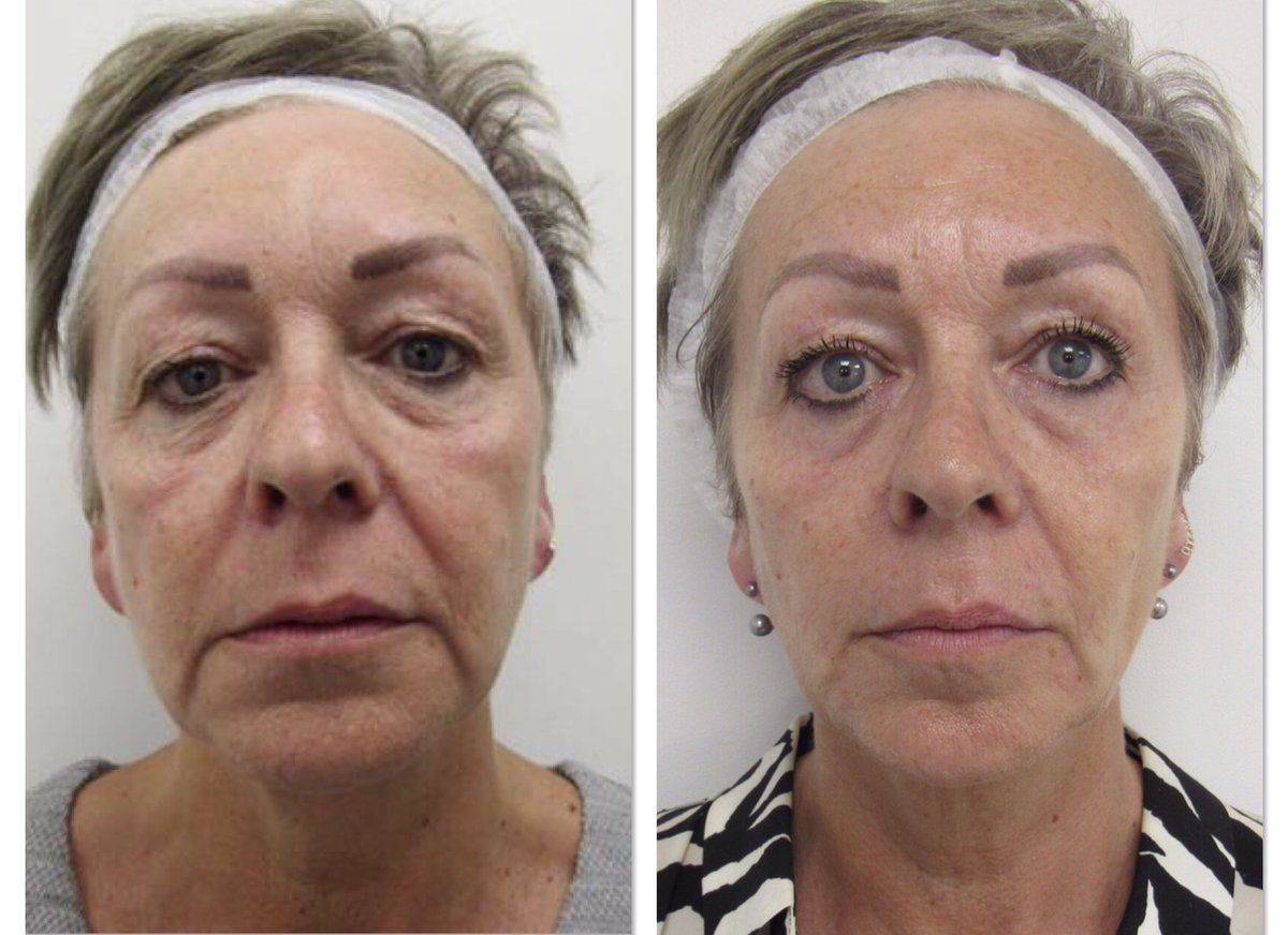Подтяжка лица после 50 лет без операции, отзывы о нитевом лифтинге | expert clinics