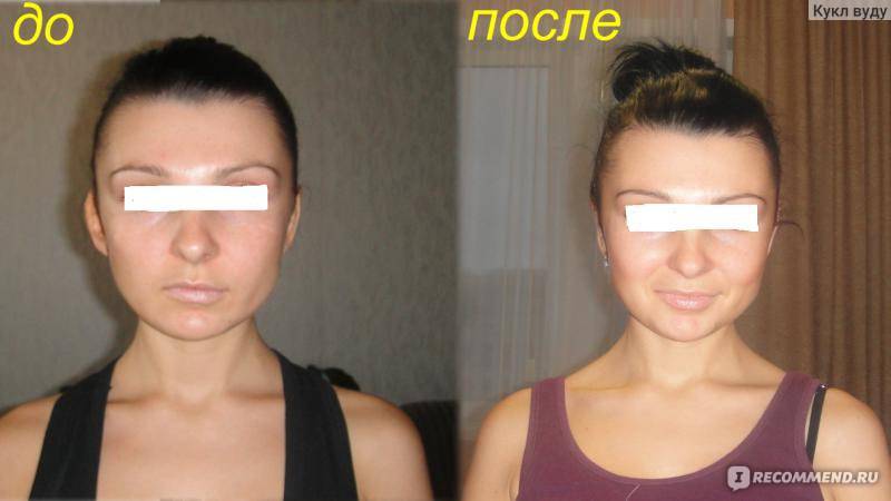 Отопластика – пластика ушей