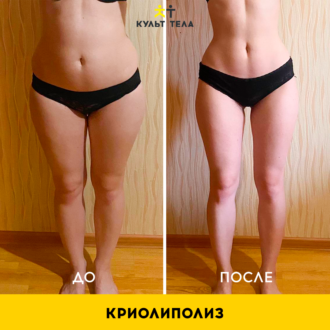Липосакция бедер