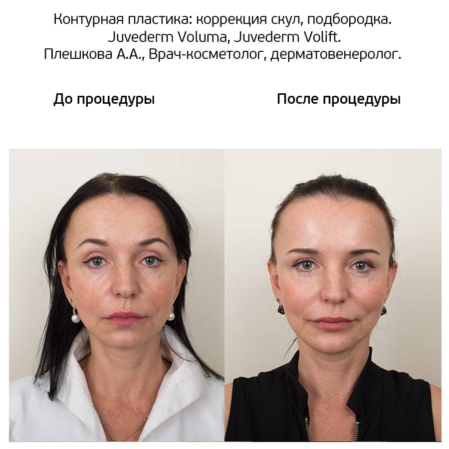 Контурная пластика лица – что это такое и в чём успех? (2021)