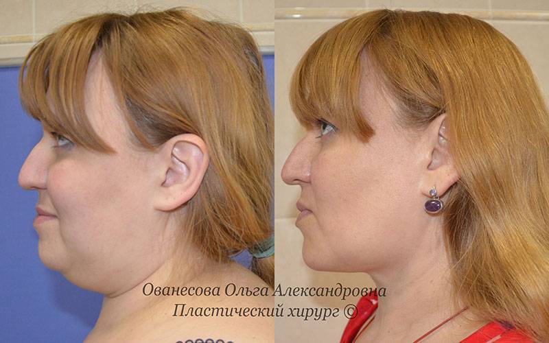 Лазерный липолиз. Что это такое, как делается, показания, противопоказания