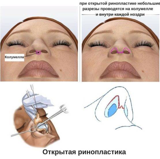Инъекционная ринопластика: чем она хороша и чем опасна