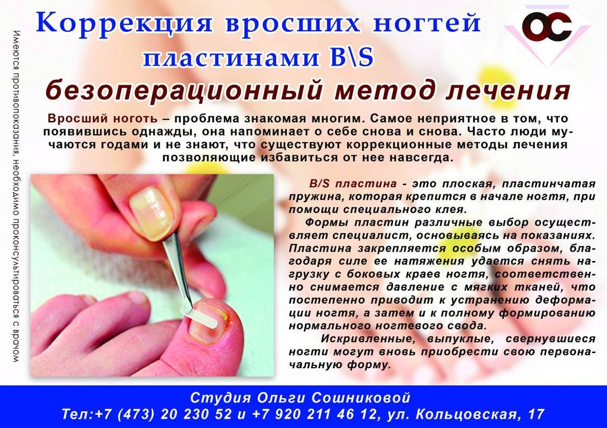 Удаление вросшего ногтя: операция и её виды, лазером и хирургически - что эффективно?