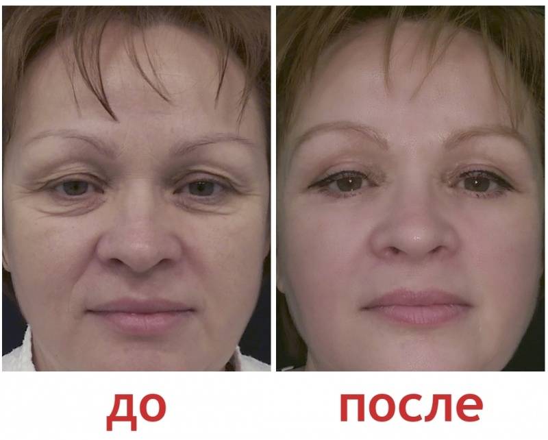 Блефаропластика верхних, нижних век. фото до и после процедуры