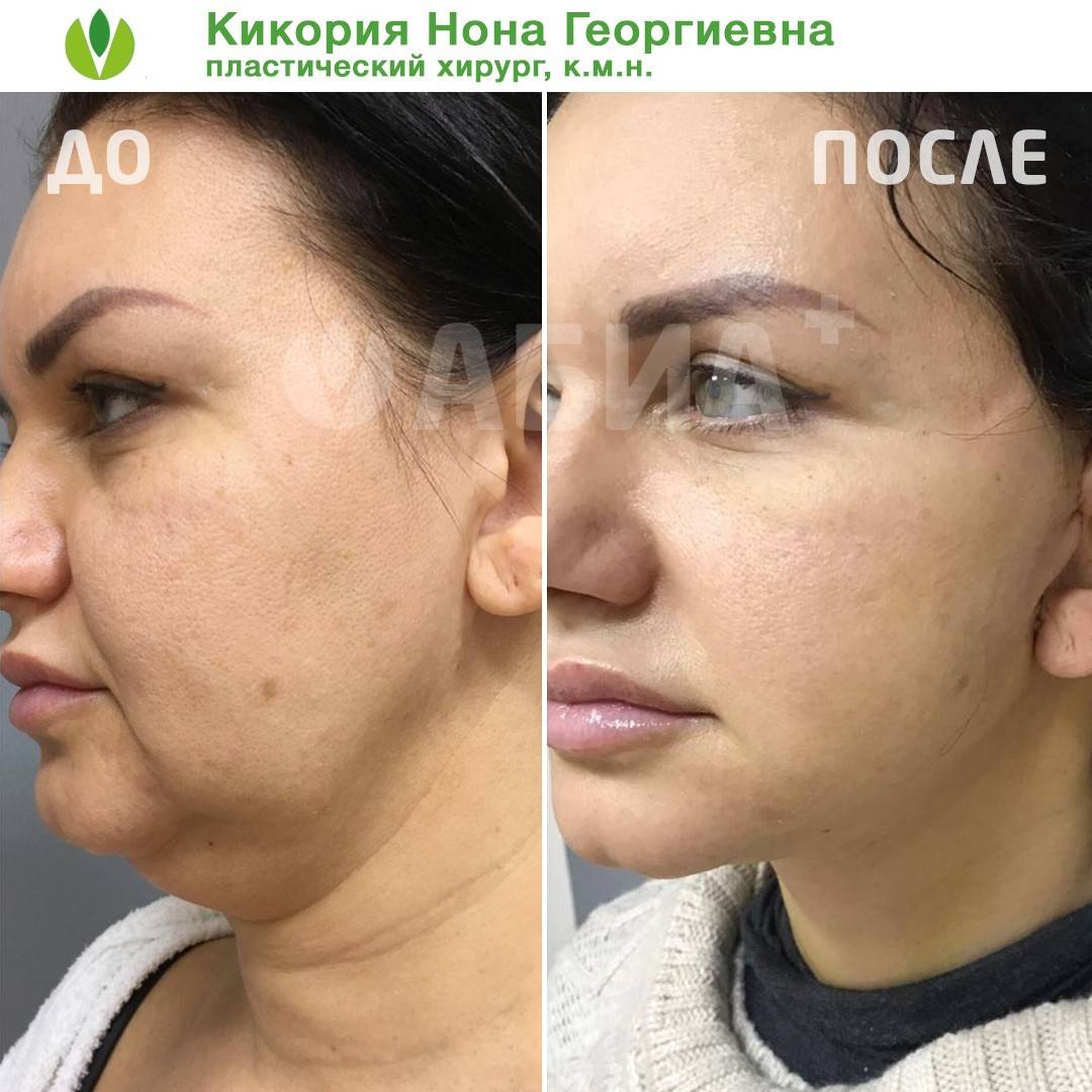 Липосакция подбородка с фото результатами до и после. нюансы реабилитации. новости о пластической хирургии и косметологии
