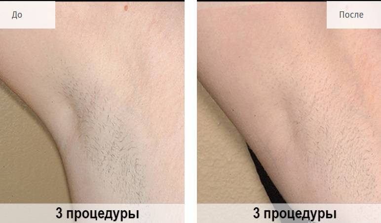 Лазерная эпиляция подмышек: как подготовиться, сколько длится, как часто нужно делать
