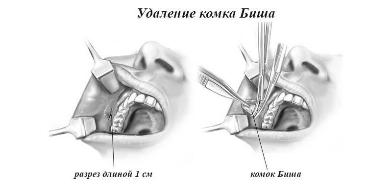Комки биша, что это такое и как от них избавиться (2021)