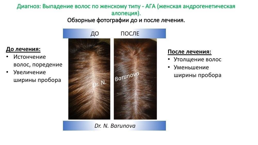 Выпадение волос: какие заболевания вызывают облысение?