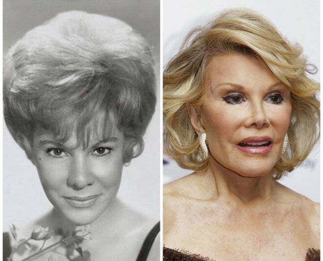 Joan rivers plastic surgery before and after photos