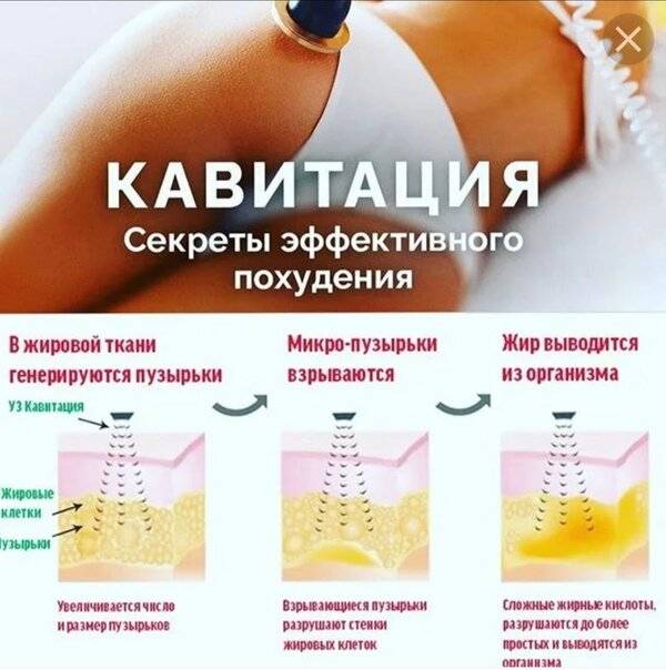 Ультразвуковая липосакция или уз-липолиз: что лучше