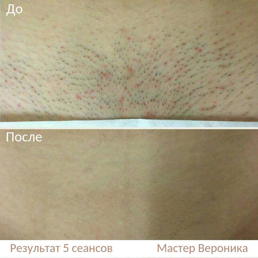 Как проходит и работает лазерная эпиляция: вся правда о процедуре удаления волос