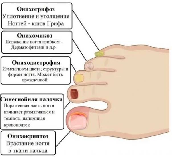 Заболевания ногтей и их симптомы