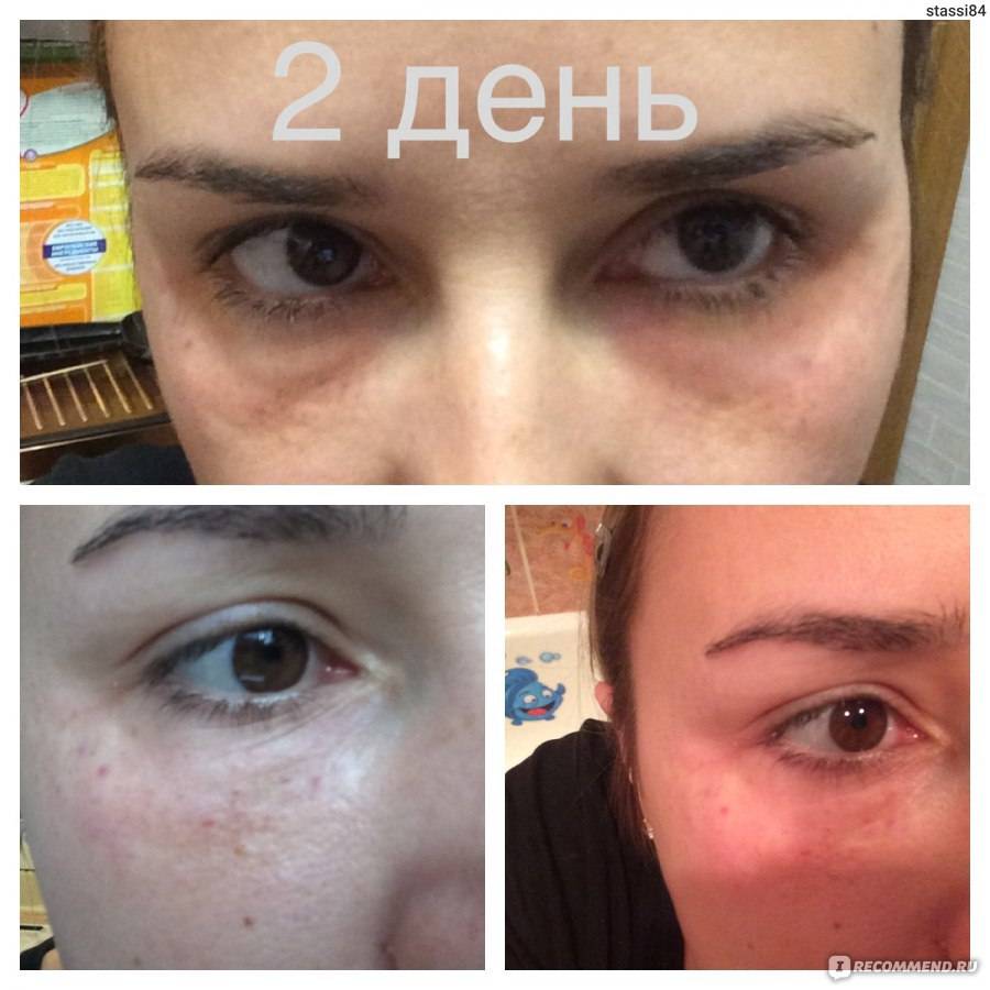 Сколько держатся папулы после биоревитализации – школа европа | школа красоты европа | курсы парикмахеров, маникюра и педикюра, косметологов и косметологии | обучение визажистов и стилистов