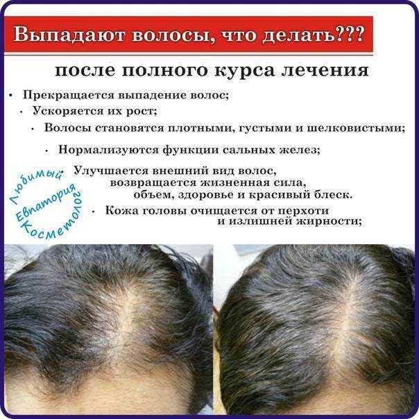 Эффективные народные средства от облысения у мужчин в домашних условиях