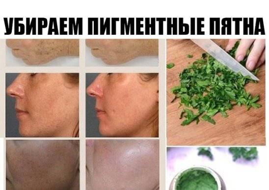 Борьба с пигментными пятнами в домашних условиях
