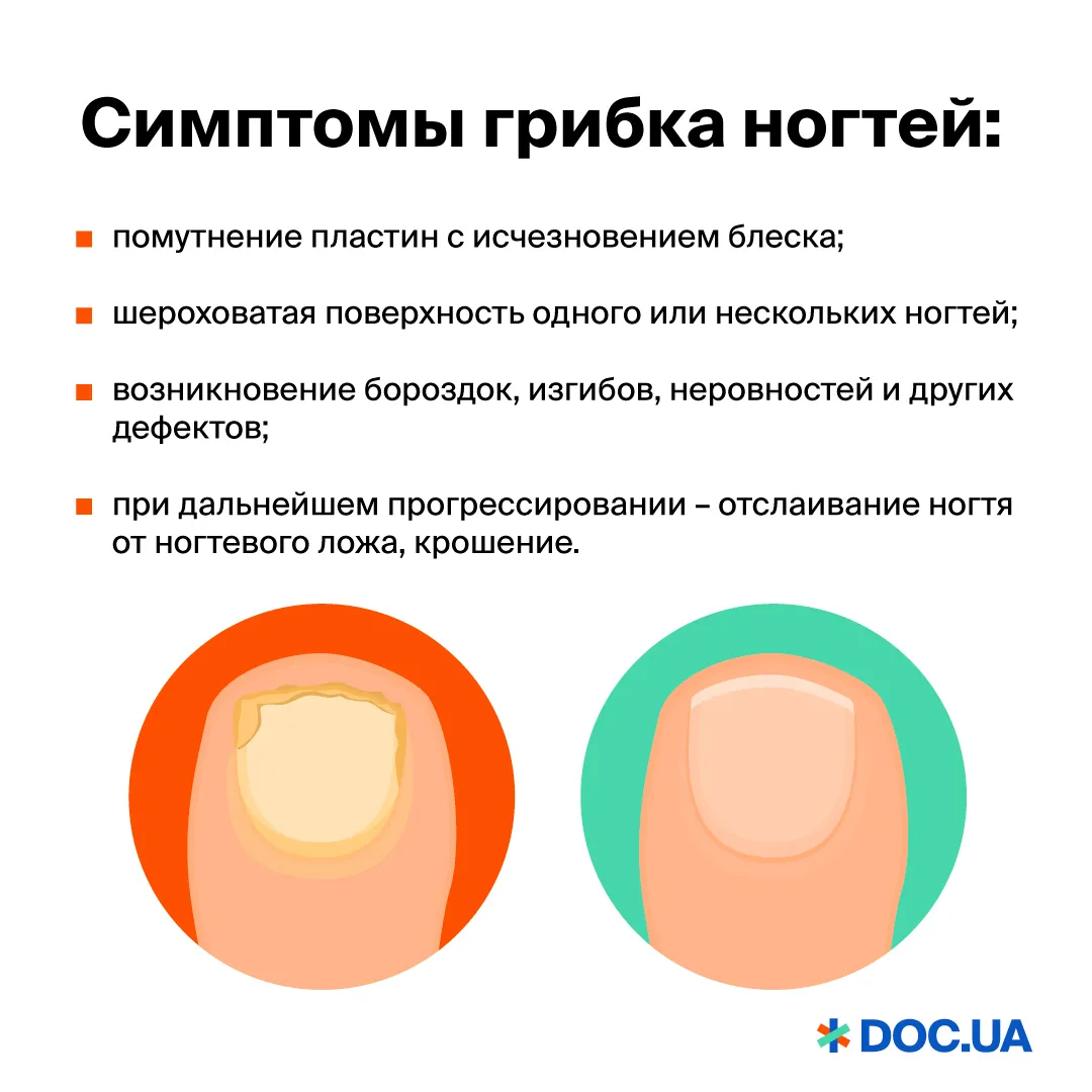 Что такое грибок ногтей? источники и причины инфекции