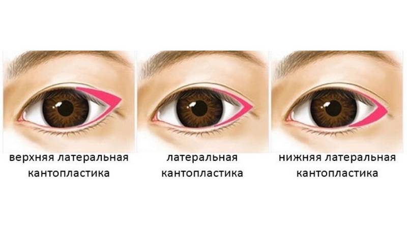 Кантопластика: до и после процедуры, варианты - медиальная, литеральная, нижняя и наружная, что лучше - кантопексия или кантопластика | marykay-4u.ru