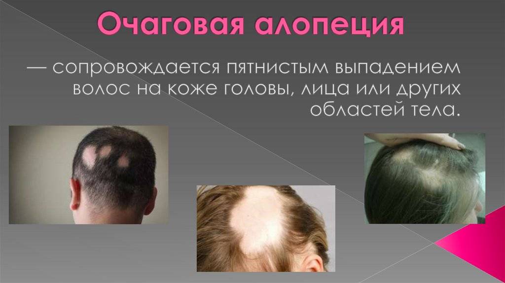 Очаговая алопеция у детей лечение — волосы
