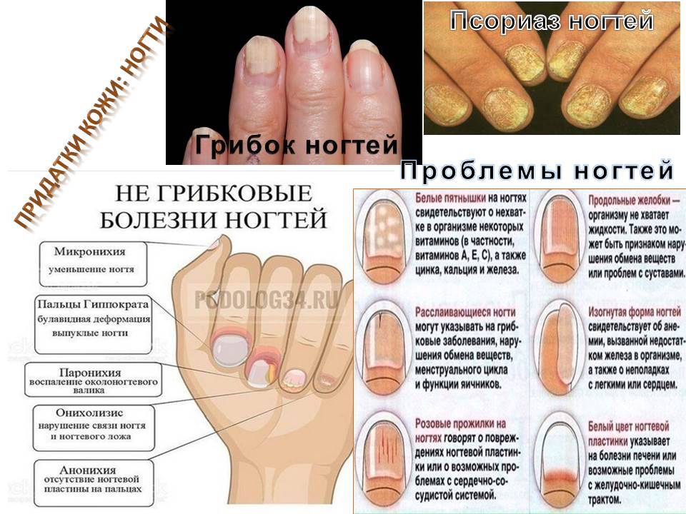 Неровные ногти: почему на них появляются точки, бугорки и бороздки