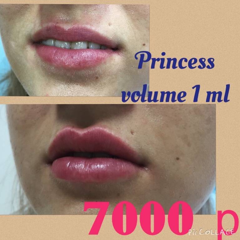 Принцесс волюм (princess volume) - самый популярный препарат линейки филлеров princess