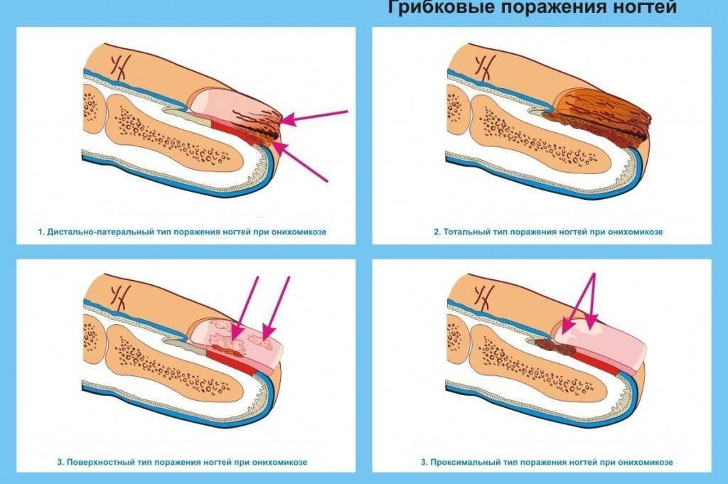 Болезни ногтей на ногах и руках, фото, описание, симптомы