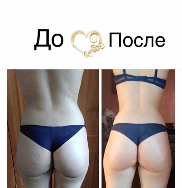 ✅ вторая попа. как убрать складки под ягодицами? основные принципы кайлатеса - elpaso-antibar.ru