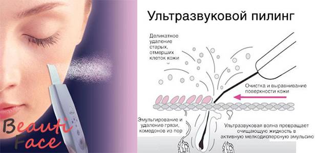 Чистка кожи ультразвуком — аппаратный пилинг лица