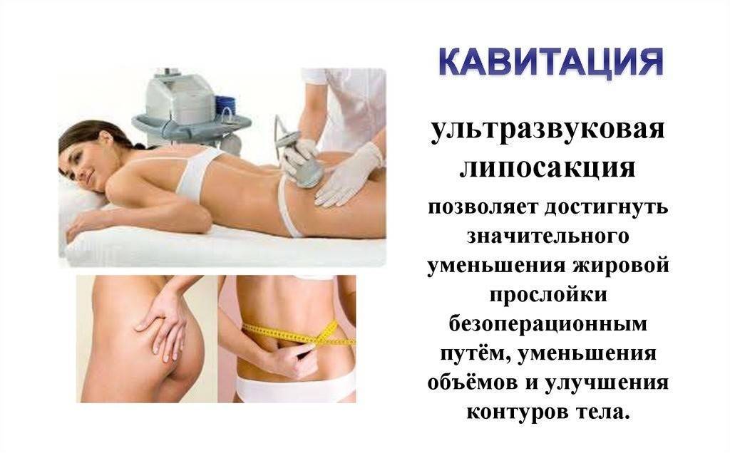 Что такое ультразвуковая кавитация тела, помогает ли от целлюлита, эффективность и преимущества процедуры, сравнение с rf лифтингом, отзывы