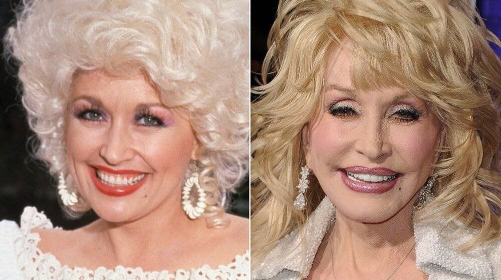 Dolly parton plastic surgery (bob job done) before after - plastic surgery talks