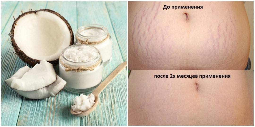 Как избавиться от растяжек на животе после родов