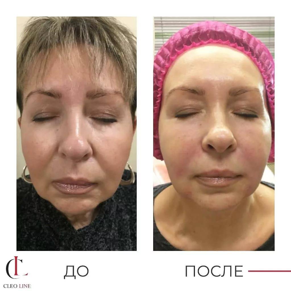 Radiesse (радиесс): применение, безопасность и научные данные | портал 1nep.ru