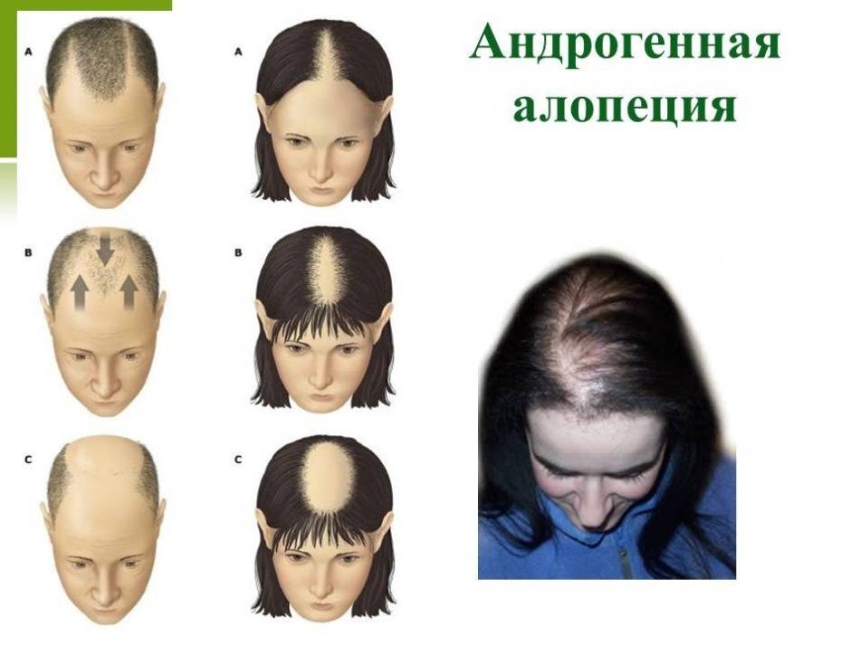 Алопеция у женщин: причины, диагностика, лечение, профилактика