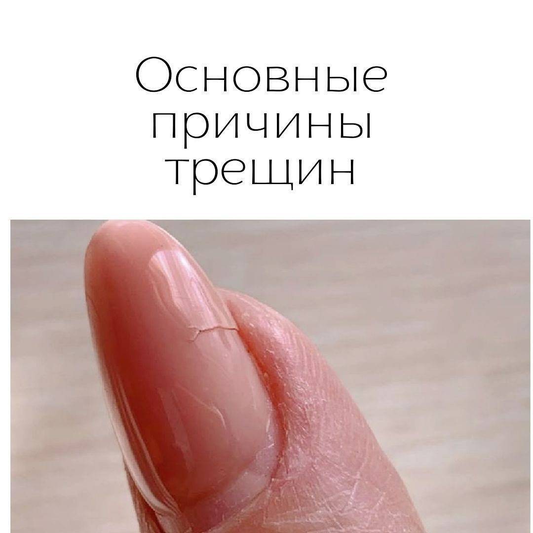 Почему слоятся ногти: чего не хватает организму и как их вылечить?