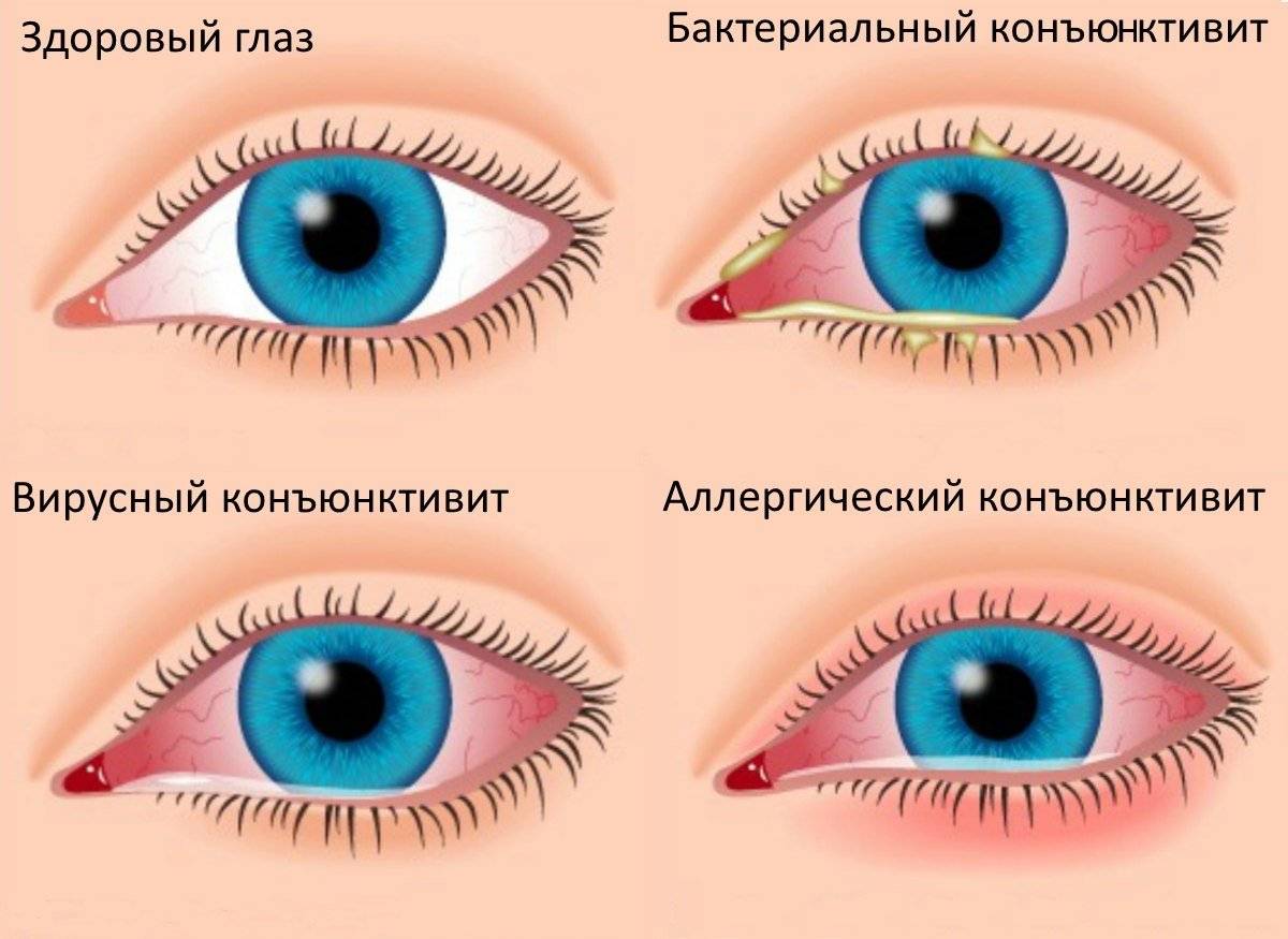 Покраснение век, повышенное слезотечение, появление выделений из глаз у детей: причины, осложнения, лечение и диагностика