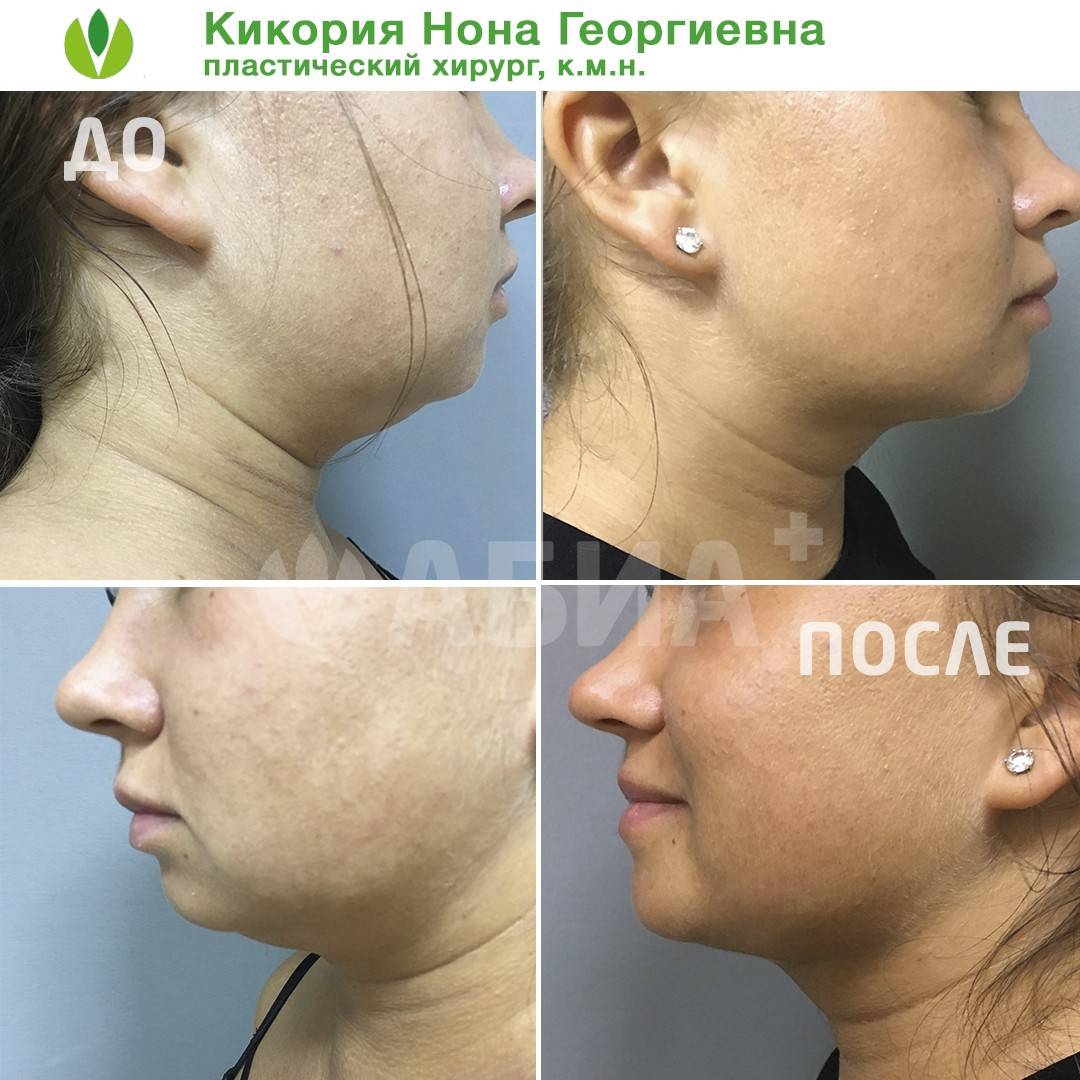 Липосакция подбородка