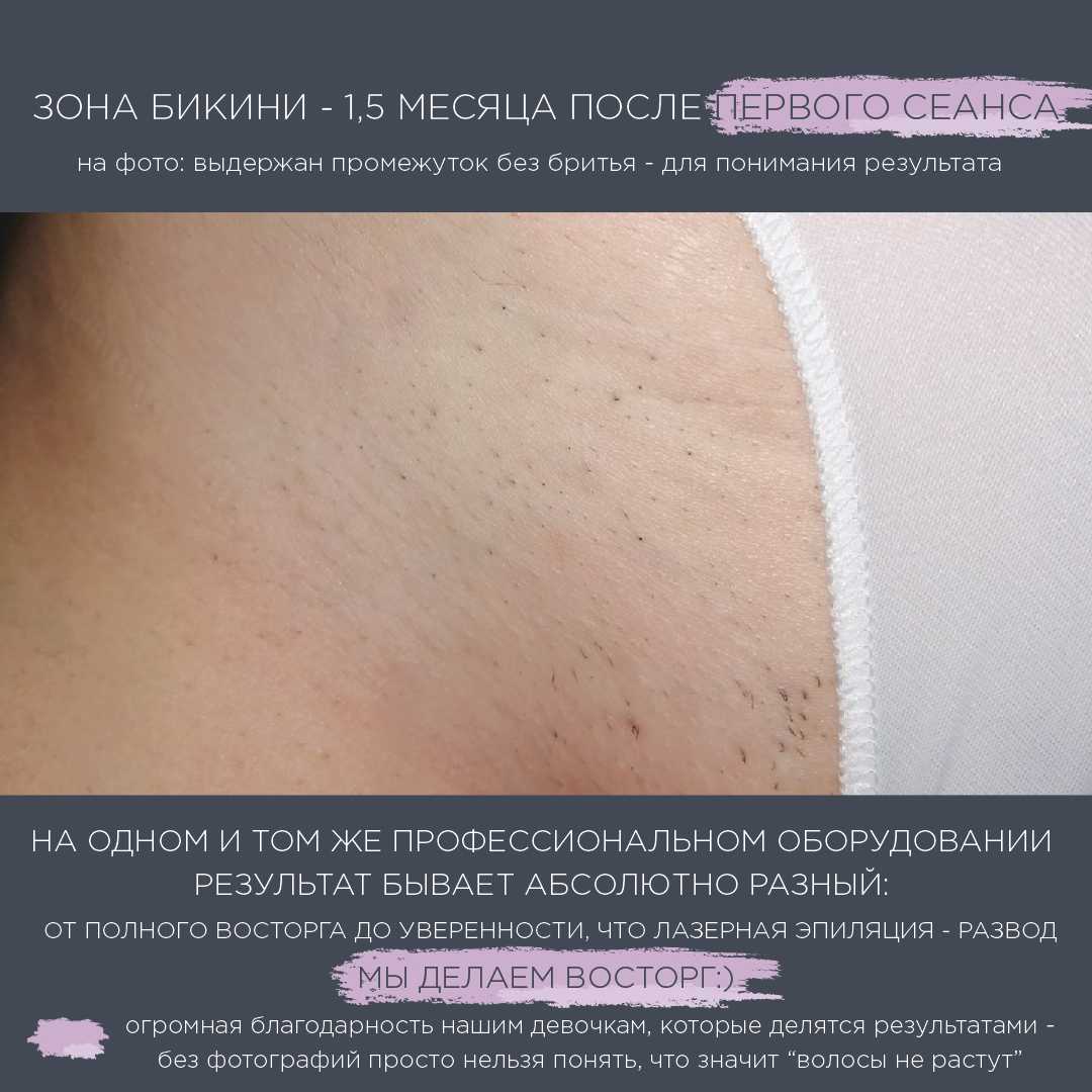 Подготовка к лазерной эпиляции — как подготовиться к удалению волос лазером
