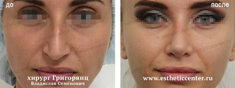 Костная мозоль после ринопластики