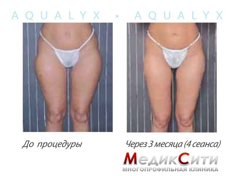 Интралипотерапия aqualyx — принцип действия, техника, эффективность и отзывы