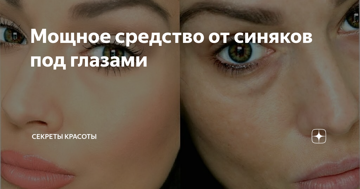 Как быстро убрать синяк под глазом от удара | vizhunasto.ru