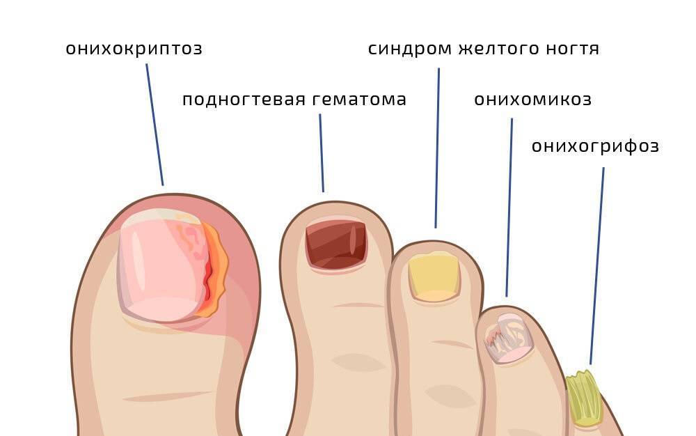 Как удалить вросший ноготь на ноге: лечение лазером, народные средства