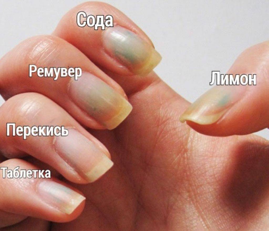Чем можно отбелить пожелтевшие ногти на ногах в домашних условиях?