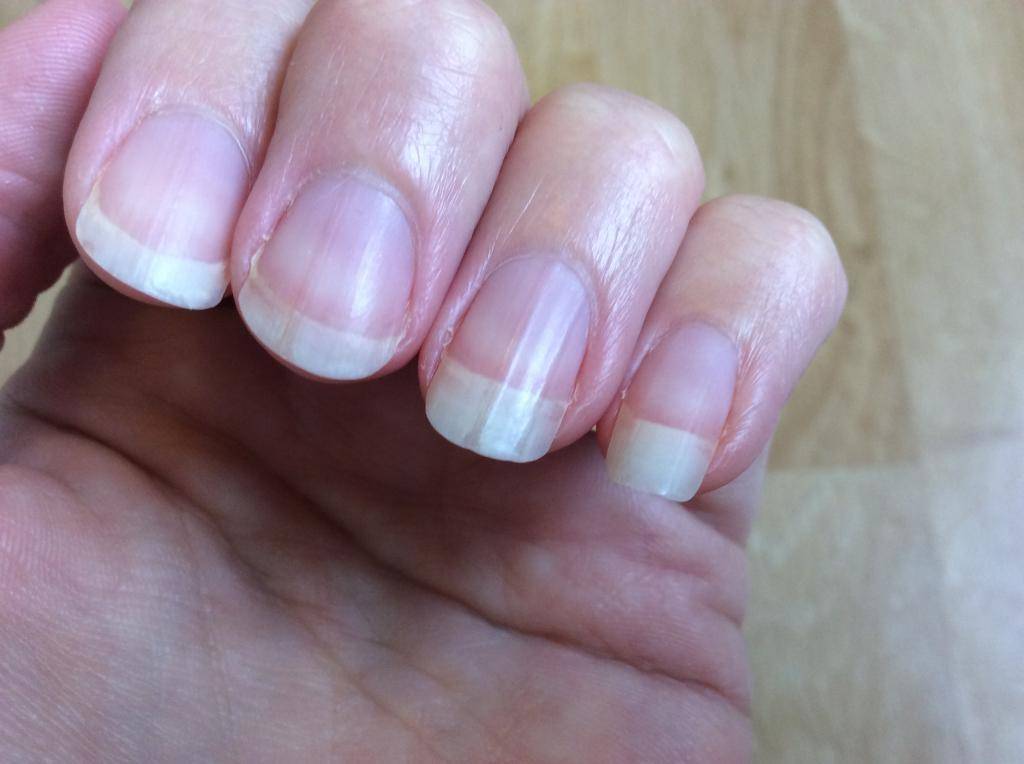 Что делать если слоятся ногти на руках: ищем и устраняем причины