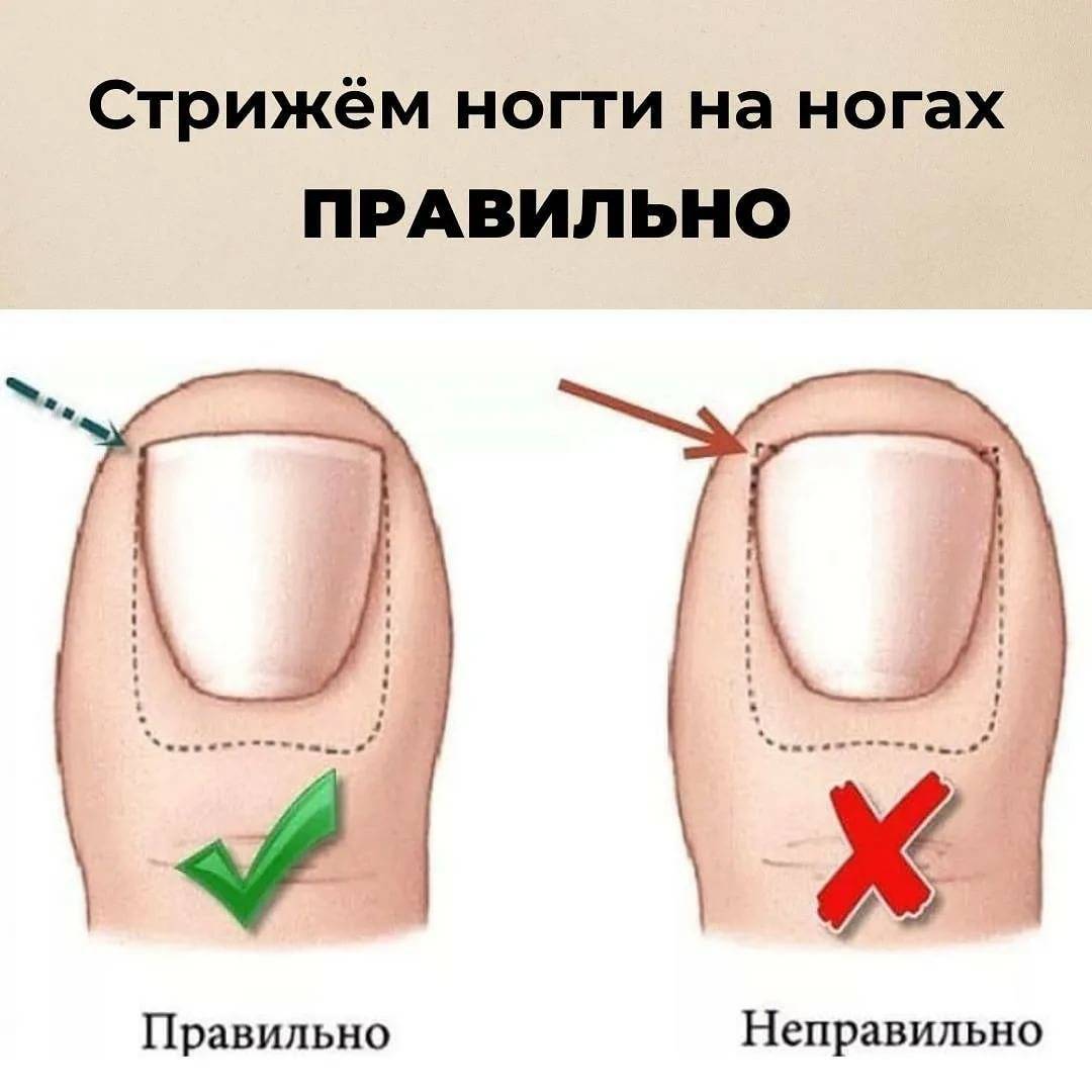 Вросший ноготь на ноге: что с этим делать - klinik.by