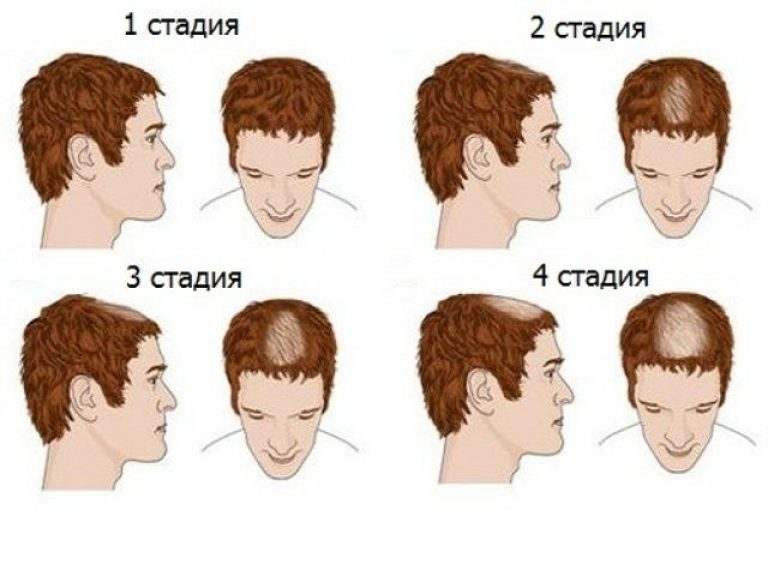 Облысение у мужчин. факторы риска, причины, лечение