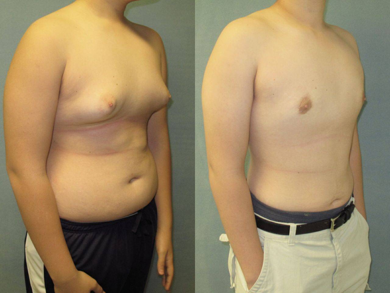ᐉ коррекция сосков и ареол при подтяжке груди | статьи | hrytsevychclinic.com