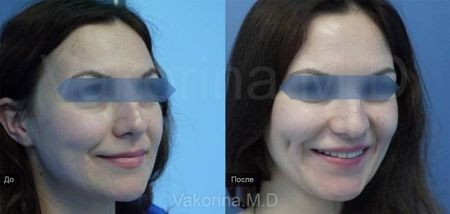 Красивые ямочки на щеках: операция и другие способы сделать поцелуй ангела