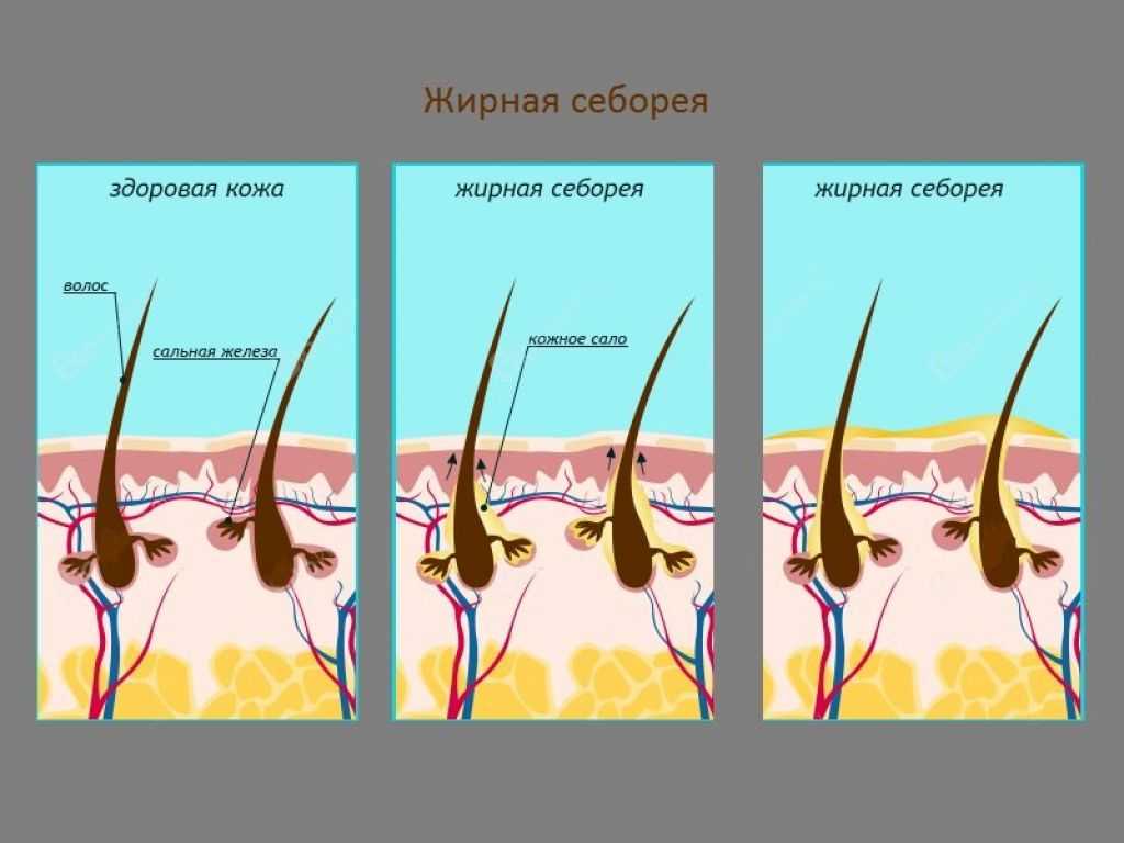 Как избавиться от перхоти - советы дерматолога - клиника "отражение"