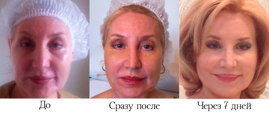 Круговая подтяжка лица: что это такое