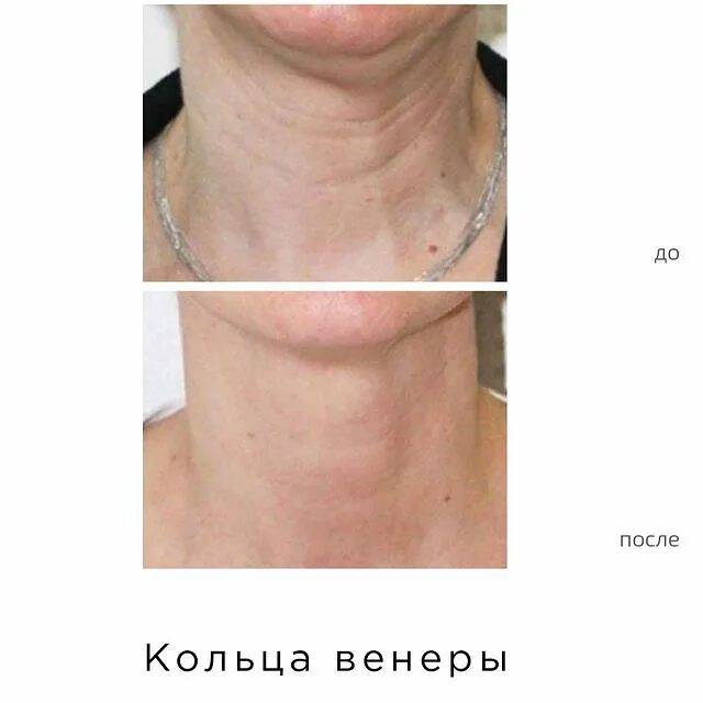 Шея и подбородок: лучшие способы восстановить контур молодости | журнал «код молодости» 👨‍⚕️