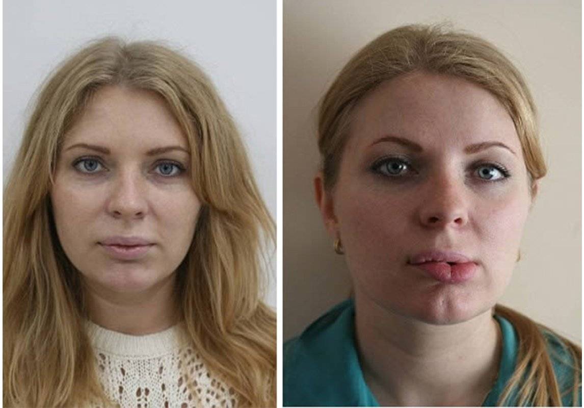 Как уменьшить губы? эффективные способы. заинтригованы?